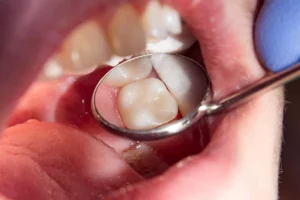 How to Know If Need Root Canal to Save a Tooth