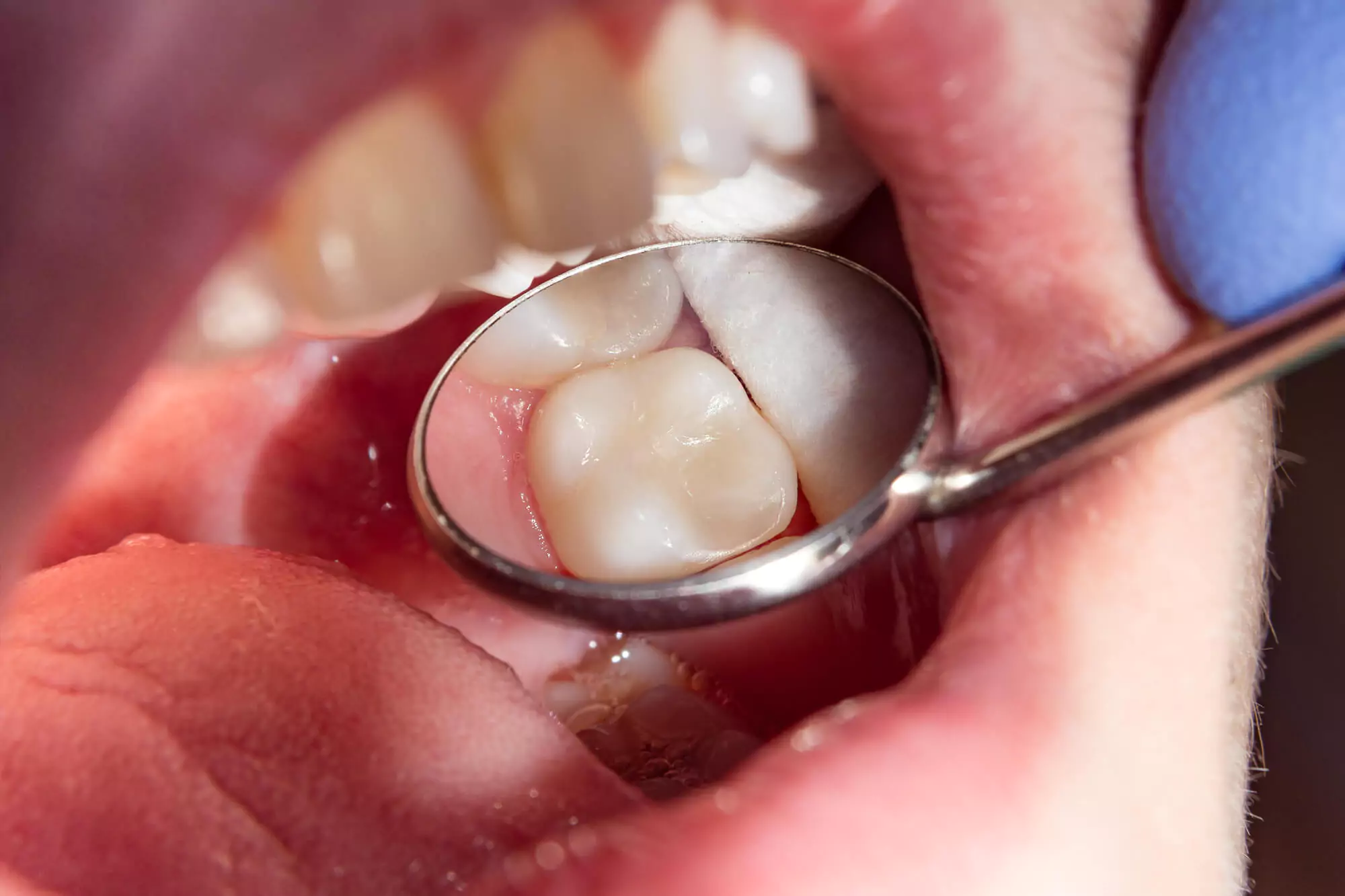 How to Know If Need Root Canal to Save a Tooth