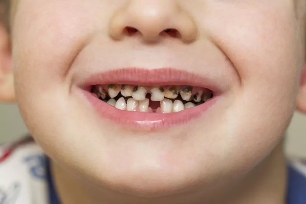 ¿La caries es hereditaria? Conoce como influye la genética
