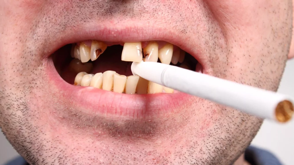 Mouth Cancer and Smoking: Protect Your Oral Health