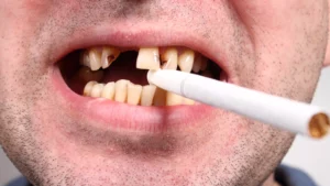 Mouth Cancer and Smoking: Protect Your Oral Health