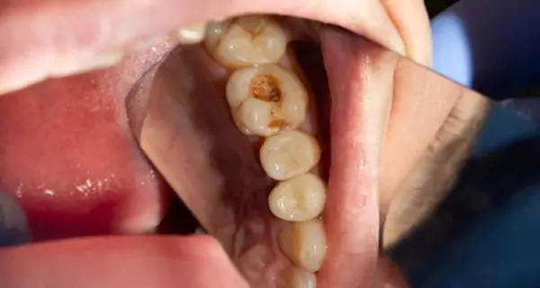 ¿Por qué podrías necesitar una endodoncia?