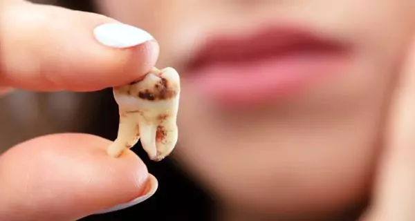 ¿Qué es la caries hereditaria?
