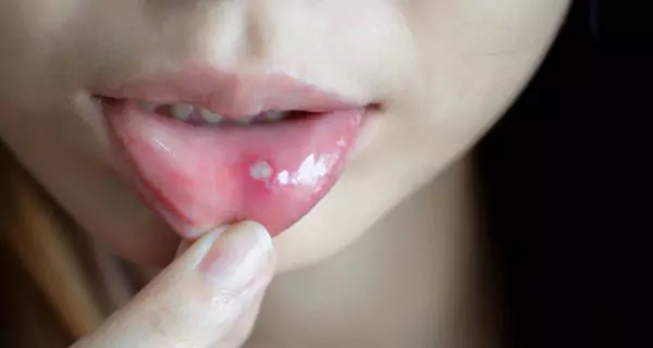 Recognizing oral ulcers in lupus