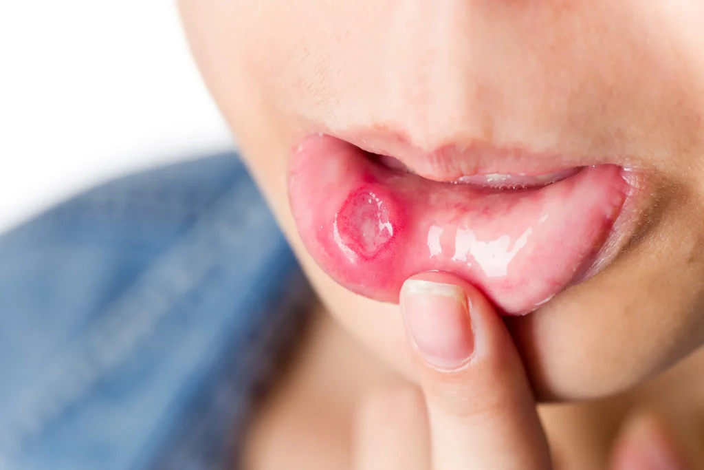 Úlceras Bucales por Lupus: Consejos para el Cuidado Oral
