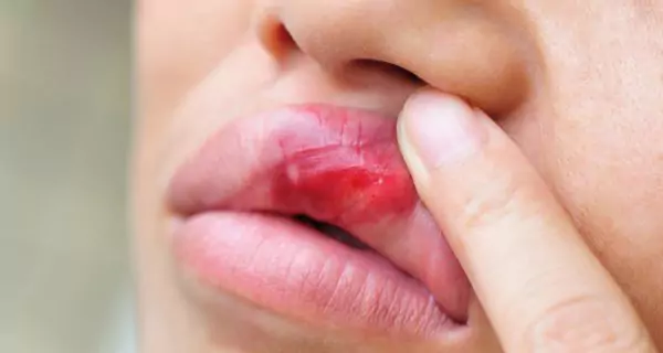 Understanding oral ulcers in lupus