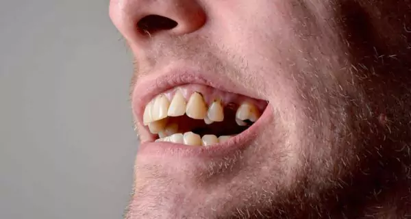 What does genetic tooth decay mean?