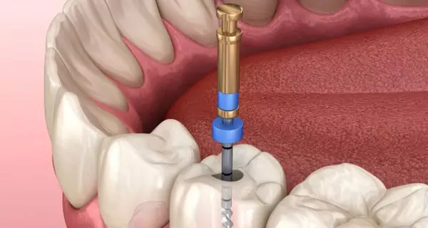 What is a root canal and why is it needed?