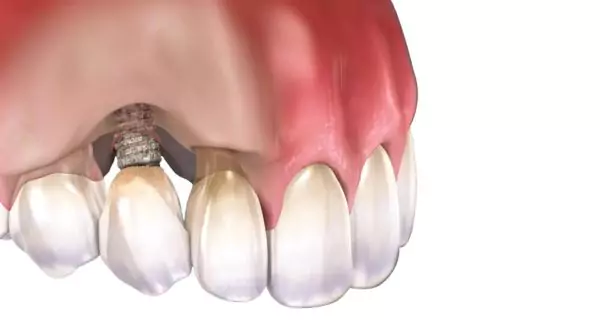 Can an infection around the implant lead to failure?