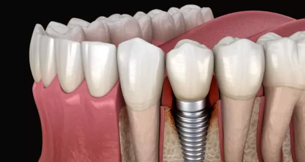 ¿Cómo afecta la infección (periimplantitis) al éxito del implante?