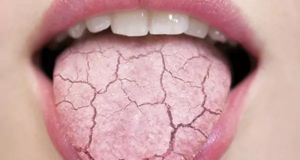 ¿Cómo afecta la miastenia gravis al cuidado dental?
