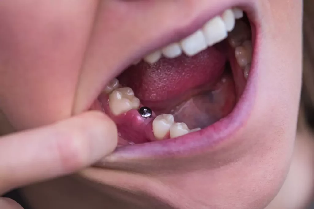 What Is a Failed Implant and How Do You Recognize It?