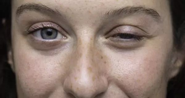 What are the common symptoms of myasthenia gravis?