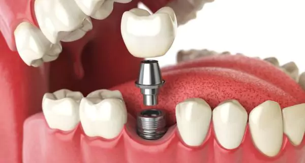 What is a failed implant?