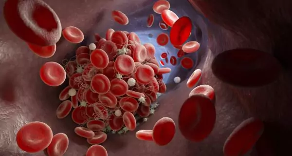 What is Antiphospholipid Antibody Syndrome (APS)?