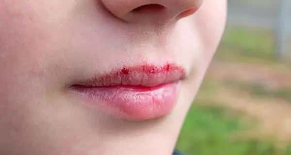 Why are sunny days risky for your lips?