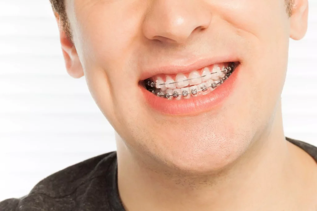 Which Type of Dental Retainers Is Right for You?