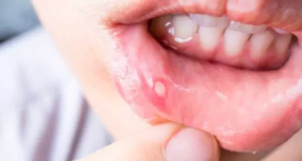 ¿Cuáles son los síntomas reportados por el uso de Colgate Total Clean Mint?