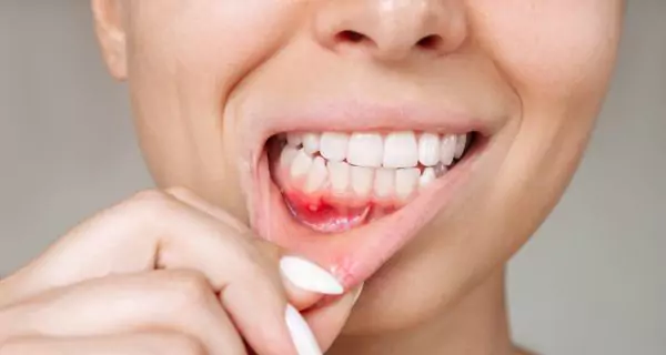 Gum disease (gingivitis or periodontitis)