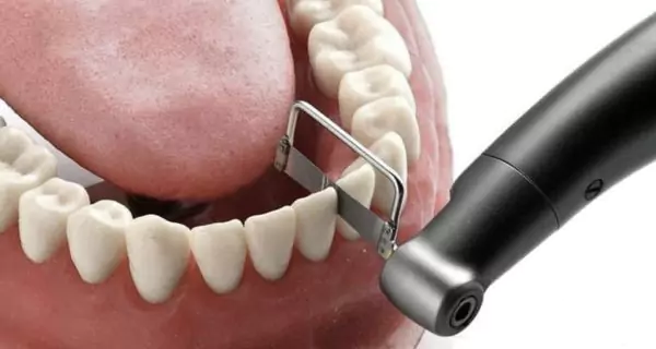 How do professionals perform interproximal reduction?