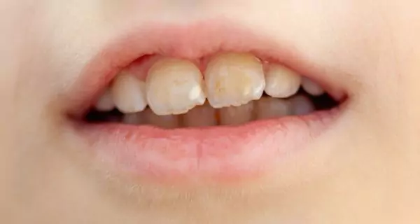How does enamel condition affect coffee stains?