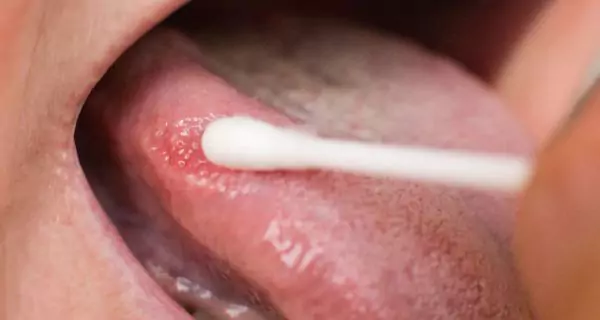 How does hepatitis affect oral health? | ¿Cómo afecta la hepatitis a la salud oral?
