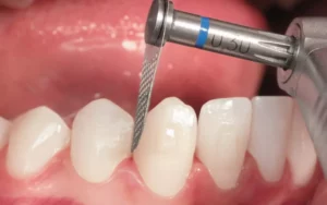 What Is an Interproximal Reduction and When is it Needed?