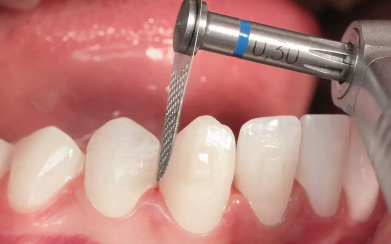 What Is an Interproximal Reduction and When is it Needed?