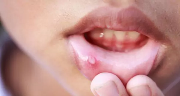 Is gentian violet safe for teeth?