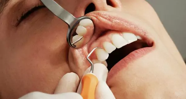 ¿Qué hace que el blanqueamiento dental sea seguro o peligroso?
