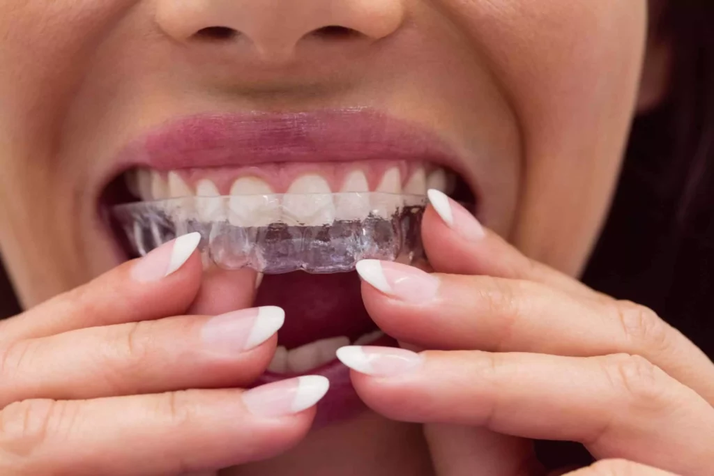 ¿Qué tipos de retenedores dentales existen y cuál elegir?