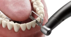 ¿Qué es el stripping dental y para qué se usa?