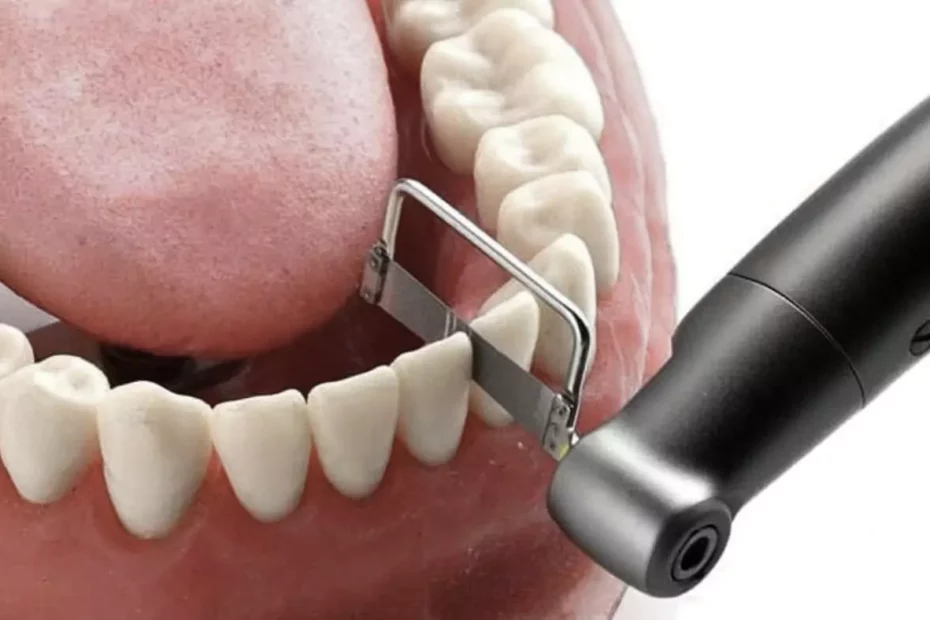 ¿Qué es el stripping dental y para qué se usa?