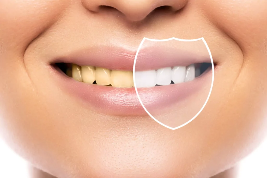 Is tooth whitening safe for those who want a brighter smile?