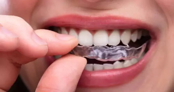 What are mouthguards for teeth grinding?