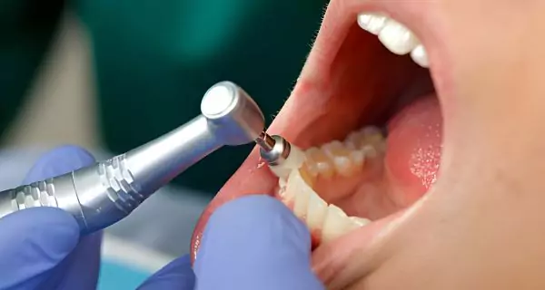 ¿Qué tratamientos ayudan a eliminar las manchas de café en los dientes?