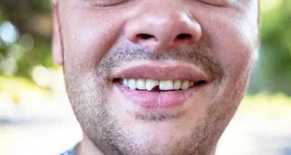 What are the most common emergency dental issues during celebrations?