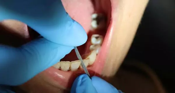What is interproximal reduction?