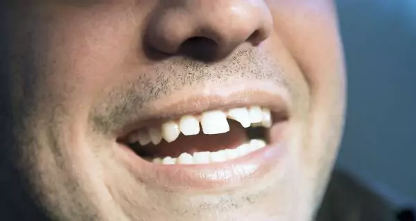 What should you do if you break or chip a tooth?