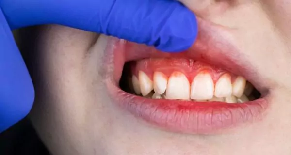 What types of mouth sores or gum problems are common? | ¿Qué otros signos orales se pueden observar en personas con hepatitis?