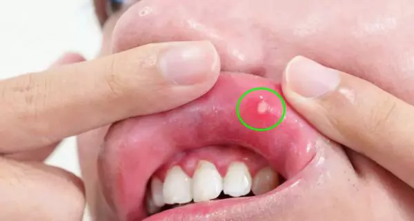 Canker sores (aphthous ulcers)