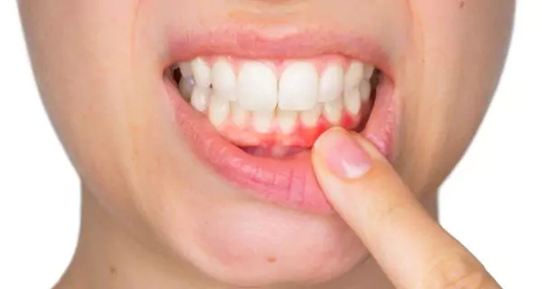 Gum disease