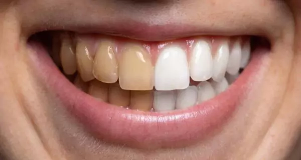 How are teeth stained?