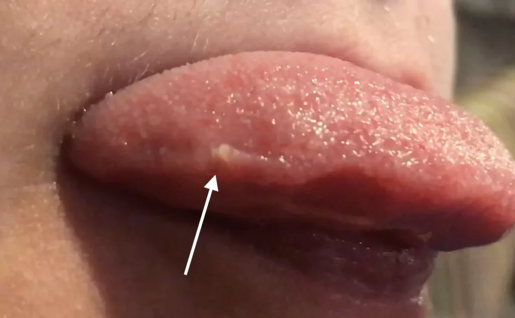 How Can You Tell If It's Lingual Papillitis?