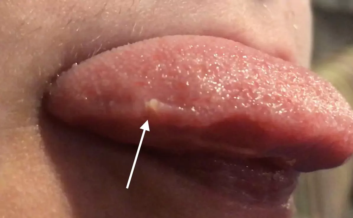 How Can You Tell If It's Lingual Papillitis?