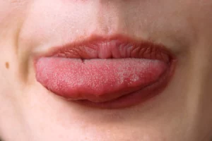¿Cómo saber si tengo papilitis lingual?