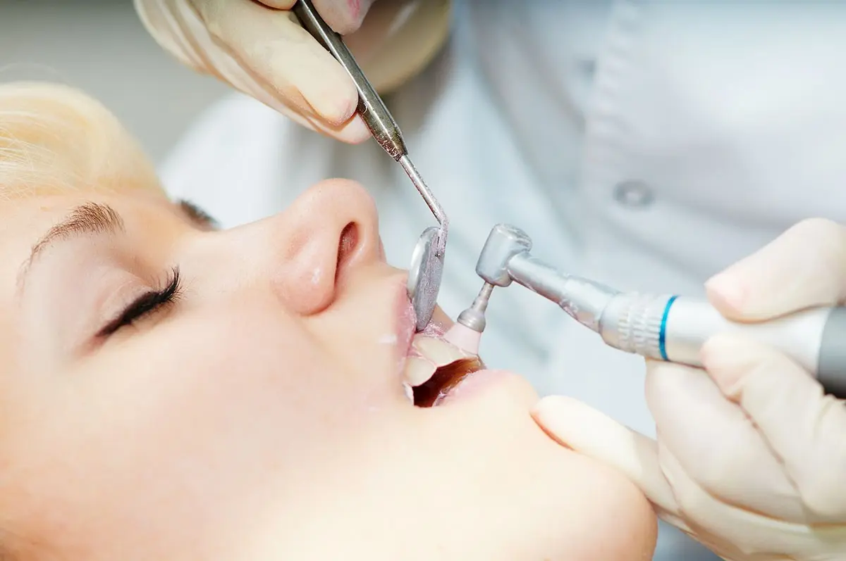 ¿El pulido dental ayuda a eliminar manchas y placa?