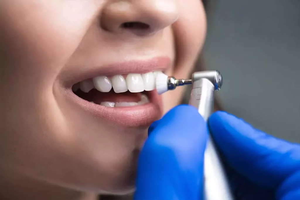 Does Teeth Polishing Make Your Smile Brighter?