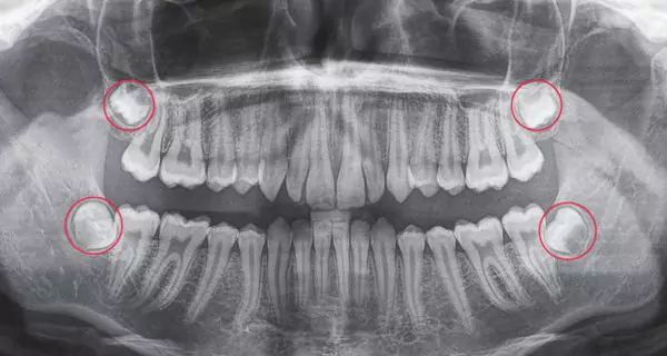 What are wisdom teeth?