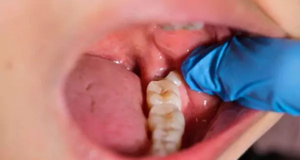 What happens if I don’t remove my wisdom teeth?